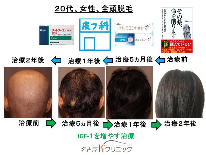 円形脱毛症　病院